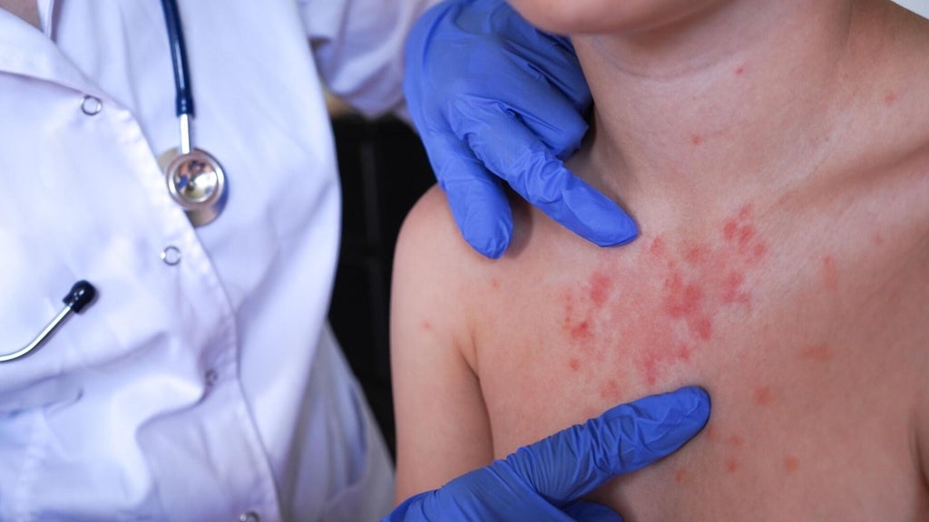 Minnesota's 80 measles cases this year are the most since 1990, health officials say — St. Louis Park Health news